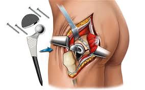 Hip replacement Treatment