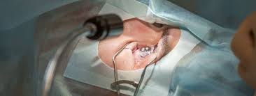 Lasik Surgery Treatment