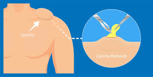 Lipoma Treatment