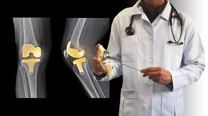 Knee replacement Treatment